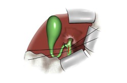 Cholecystectomy with CBD Explorations