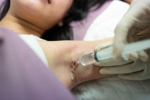 Hidradenitis Suppurativa Surgery