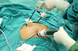 Laparoscopic Surgery for Gall Stones