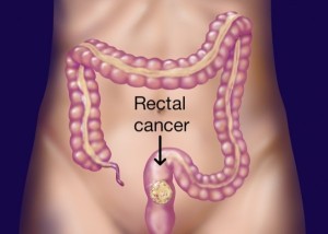 Onco Surgery for Cancer of Rectum