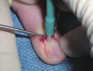 Punch / Wedge Biopsy