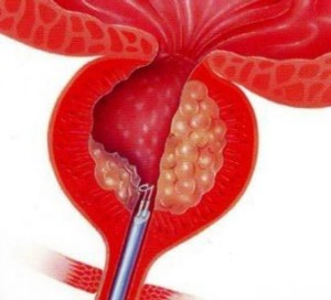 TURP for Prostate Enlargement